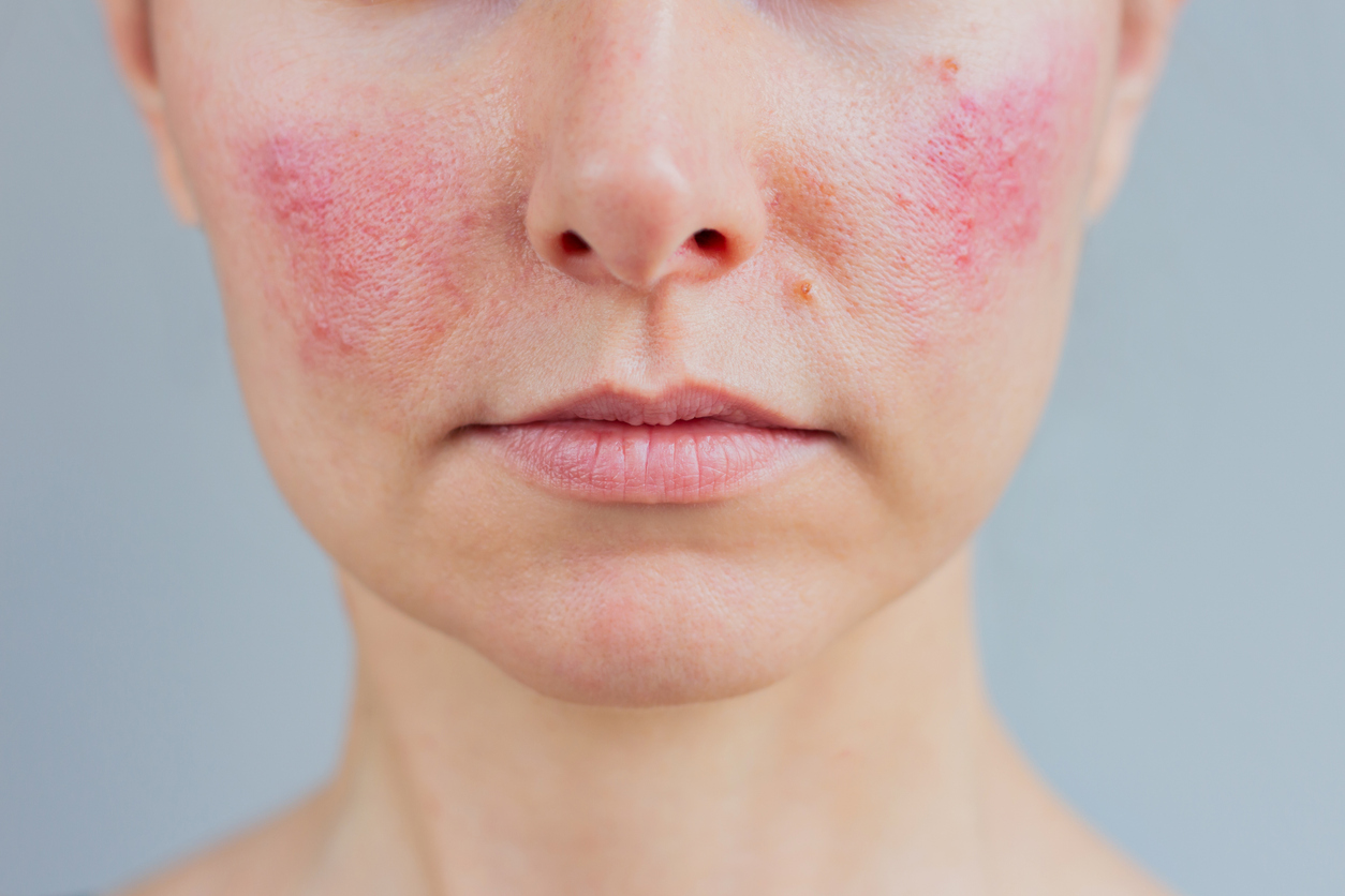 Close-up of facial redness and acneiform skin inflammation on the cheeks