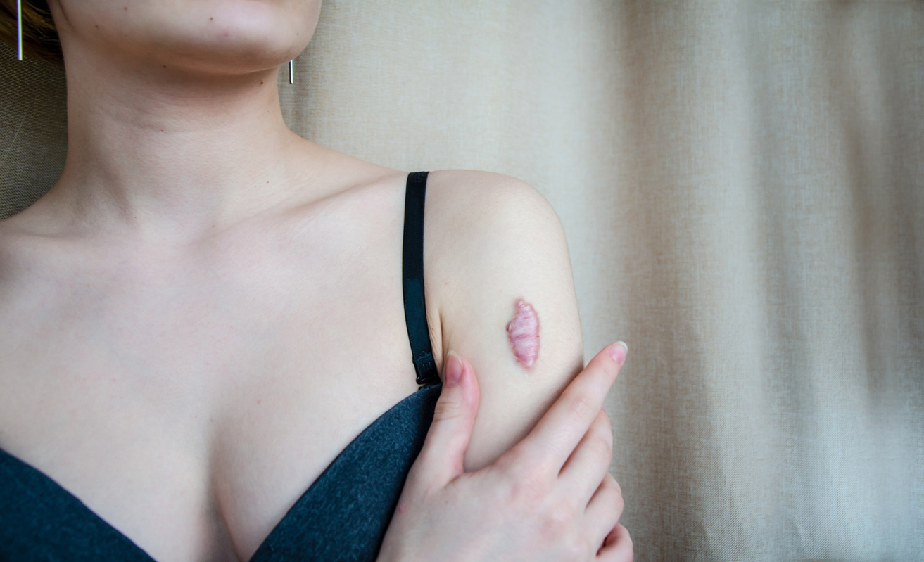 Raised keloid scar on a person's shoulder