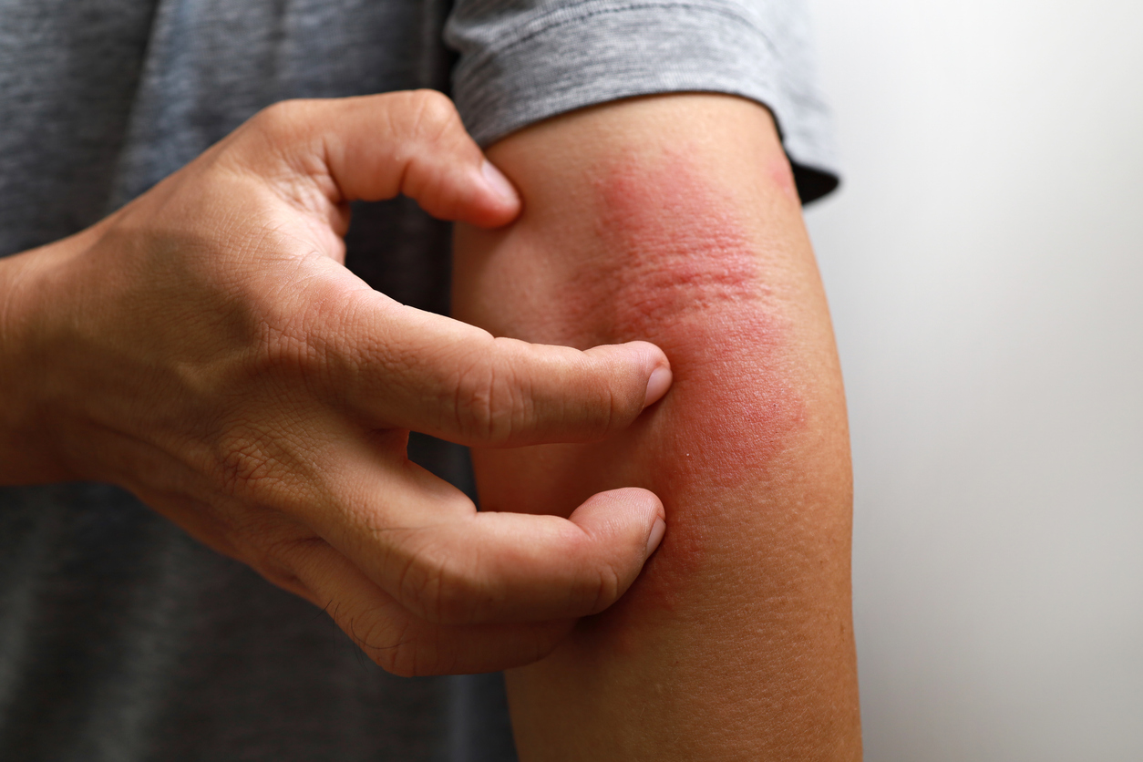 Close-up of a person scratching a red, inflamed rash on the arm